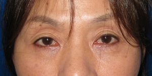 目の下のたるみ、目のくまでお悩みの方、切らずに完璧に解決します。TCB-R法　手術直後　症例写真